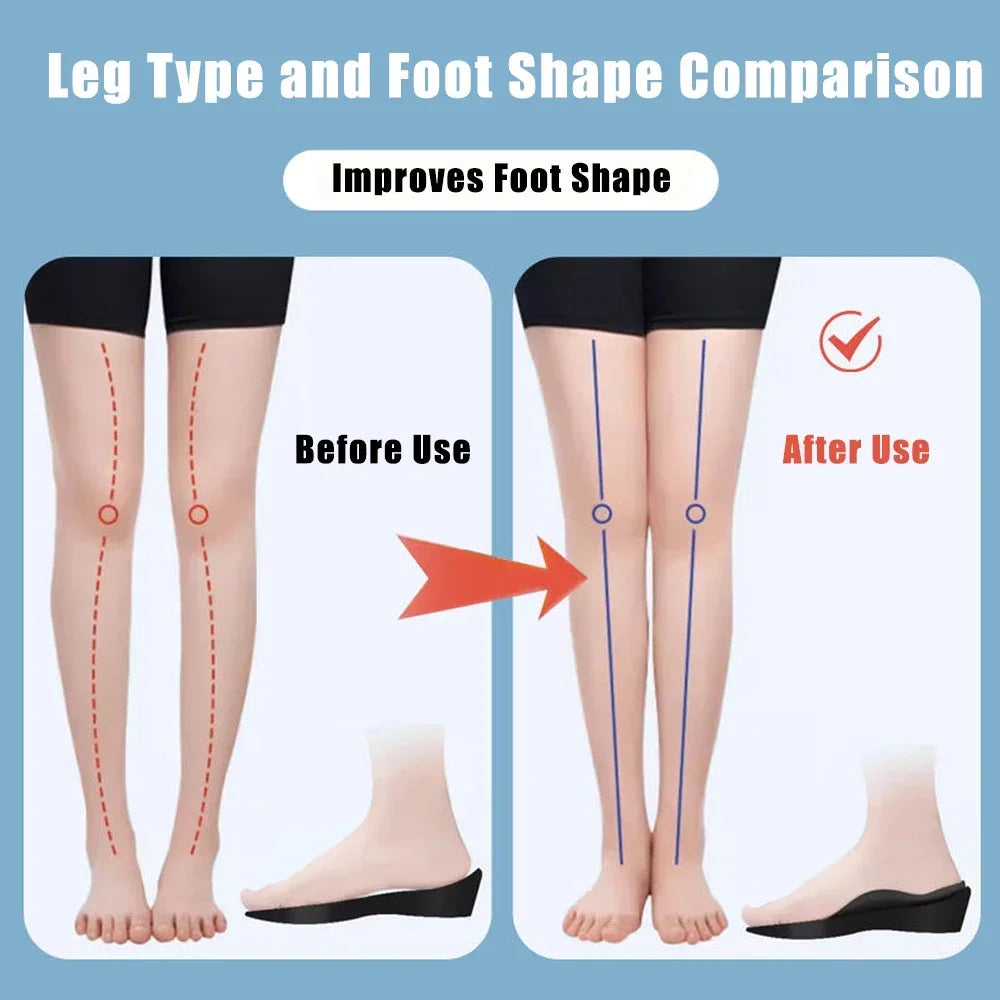 For Shoes Women Men XO-Legs Corrector Orthotic Insoles for Plantar Fasciitis Pain Relief Therapy Flat Feet Arch Support Insoles